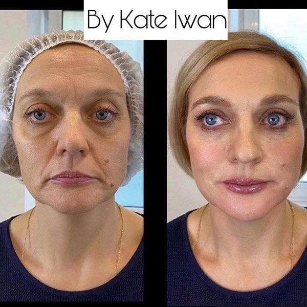 Premium Skin Booster & Botox (Forehead)